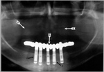 Dental implant