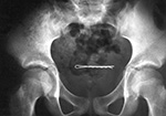 Bobby pin in the bladder 