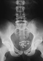 Bladder wire and calculi