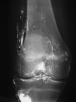 Bullet shrapnel