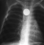 Coin in esophagus