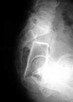 Drinking glass in the rectum