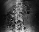 Fishooks in duodenum