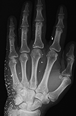 Shrapnel in the hand