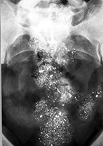 Lead in the colon