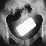 Lighter in the rectum