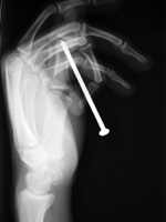 Nail gun injury