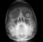Orbital prosthesis