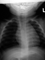 Paper clasp in hypopharynx