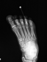 Pen in foot