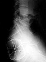 Can in rectum