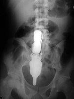 Cordless screwdriver in the rectum