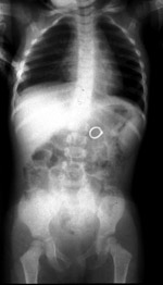 Ring in the stomach