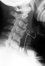 Safety pin in throat