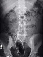 Ship in bottle in rectum