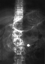 Silver nitrate in the stomach