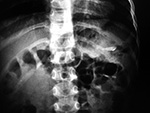 Tooth in stomach