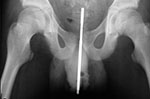 Pen in the urethra