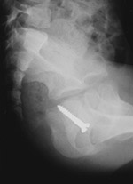 Screw in vagina
