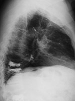 Vertebroplasty complication