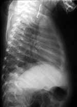 Wire in throat