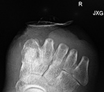 Wound Vac over metatarsal stumps