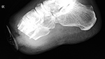 Wound Vac over metatarsal stumps