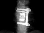 Harms vertebral cage and side plate and screws