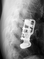 Harms vertebral cage and side plate and screws