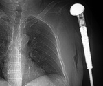 Limb sparing prosthesis