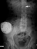 Baclofen pump