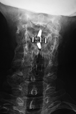 Cervical disk cages
