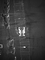 Expandable corpectomy cage CT sagittal image