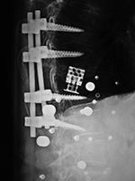 Expandable corpectomy cage after shift