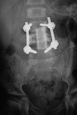 Lumbar spine disk strut
