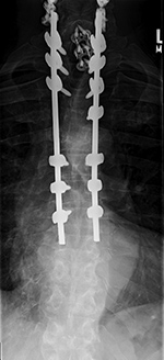 Occiput-T8 fusion