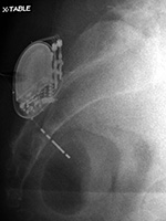 Sacral stimulator lateral view