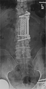 Thoracic vertebral cage and left lateral side plate AP view