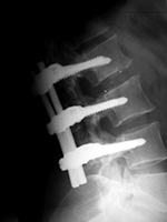 Intervertebral disk cages