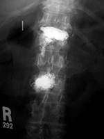 Vertebroplasty extrusion