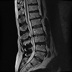 Sagittal MRI X-Stop device
