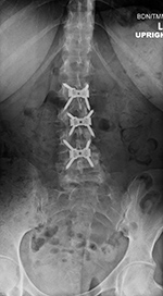Zero-profile ALIF