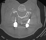 Axial CT-cervical spine fusion failure