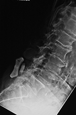 ILIF at L4-5. Lateral view flexion