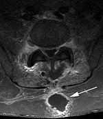 PLIF postoperative abscess axial MRI