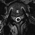 PLIF arachnoiditis axial MRI