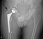 Right hip prosthesis with heterotopic bone formation