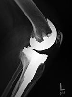 Biomet Vanguard TKA