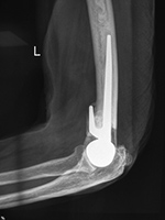 Elbow hemiarthroplasty