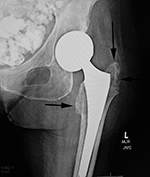 Left hip metal-on-metal prosthesis with metallosis